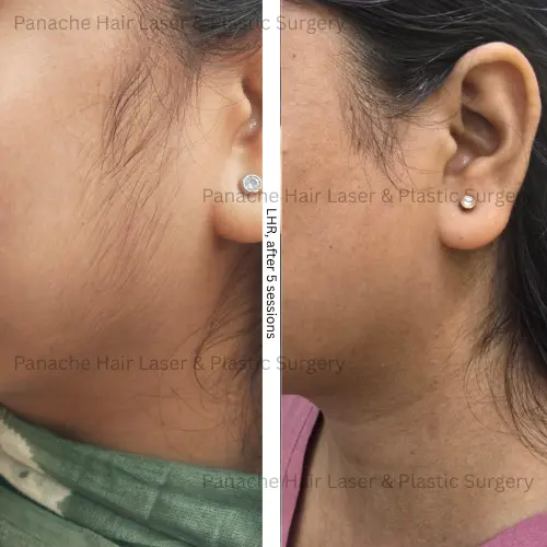Face laser hair reduction before and after result — permanent hair removal — Panache Aesthetics, Pitampura North Delhi
