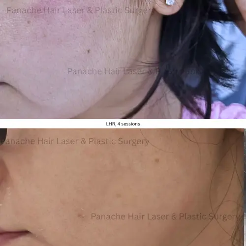 Full face laser hair removal before and after — Primelase diode laser — Panache Aesthetics, Pitampura Delhi