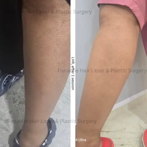 Legs laser hair removal before and after — significant hair reduction after 1 session — Primelase — Panache Aesthetics Delhi