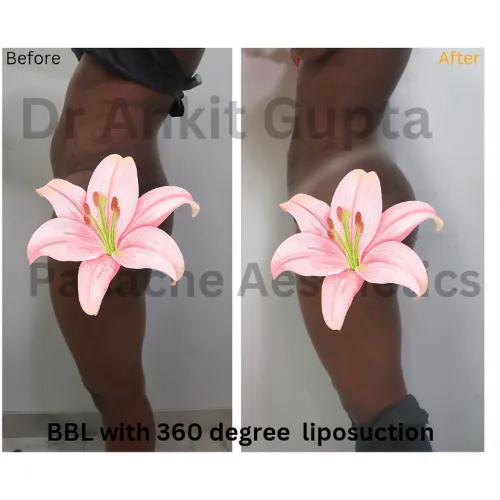 360-degree liposuction before and after — side profile showing thigh and hip contour — Panache Aesthetics, Delhi