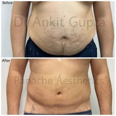 Abdomen liposuction before and after result — tummy fat removal — Delhi