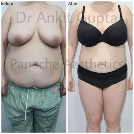 Liposuction before and after — body contouring result — Dr. Ankit Gupta, Panache Aesthetics Delhi
