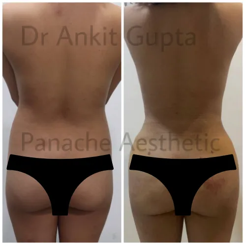 Back and flank liposuction in Delhi before and after — love-handle reduction, rear view — Dr. Ankit Gupta