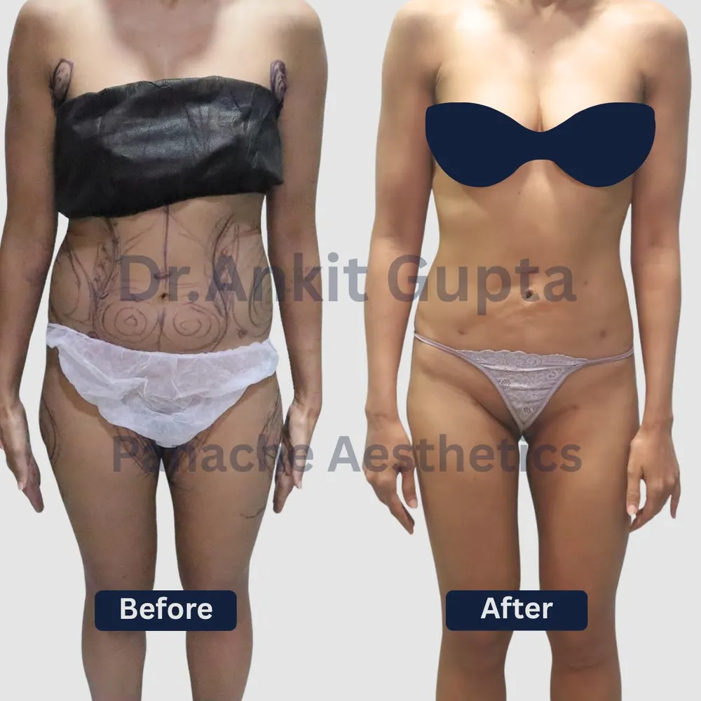 360-degree liposuction before and after in Delhi — full-body contouring, defined waist — Dr. Ankit Gupta, Panache Aesthetics