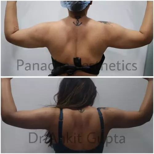 Arm liposuction before and after — toned shapely arms — Dr. Ankit Gupta, Panache Aesthetics Delhi