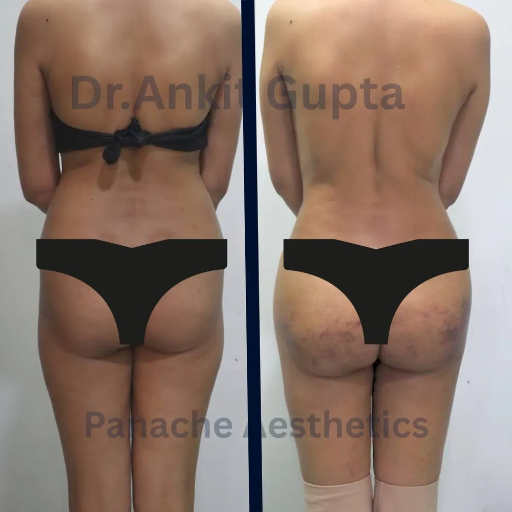 Liposuction of hips and outer thighs before and after — rear view body contouring in Delhi — Dr. Ankit Gupta