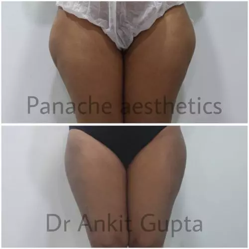 Thigh fat removal before and after — Dr. Ankit Gupta