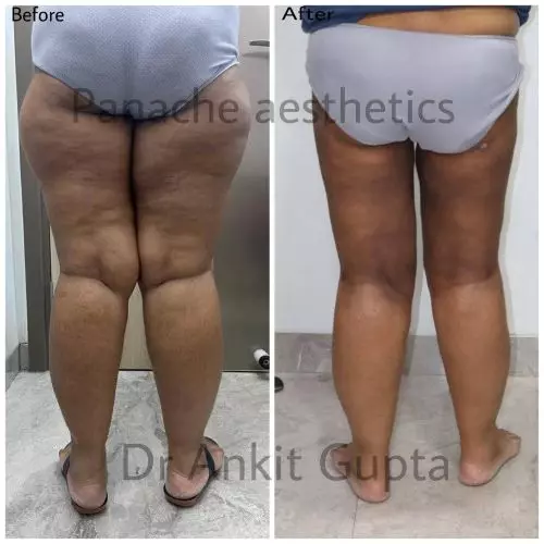 Thigh liposuction before and after result — Dr. Ankit Gupta