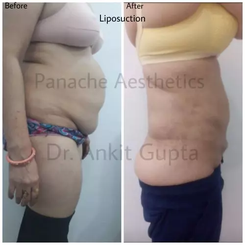 Tummy liposuction before and after — flatter abdomen — Dr. Ankit Gupta
