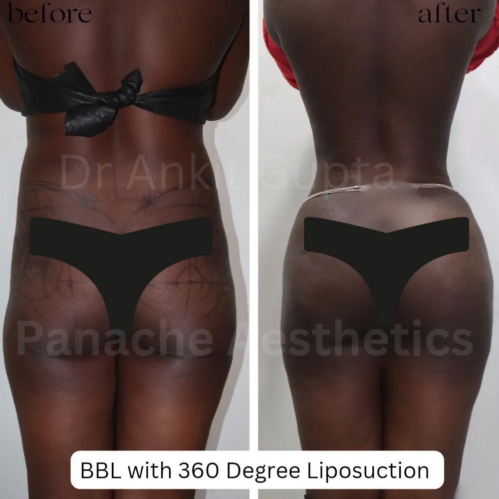 360° liposuction of love handles before and after in Delhi — smooth back and waist — Panache Aesthetics