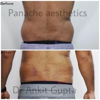 Love handles liposuction before and after — flank fat removal — Delhi