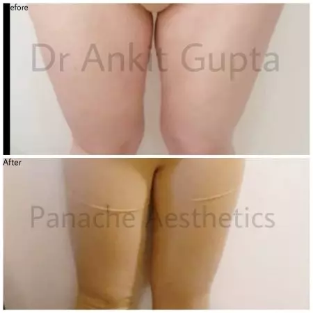 Inner and outer thigh liposuction before and after result — Delhi