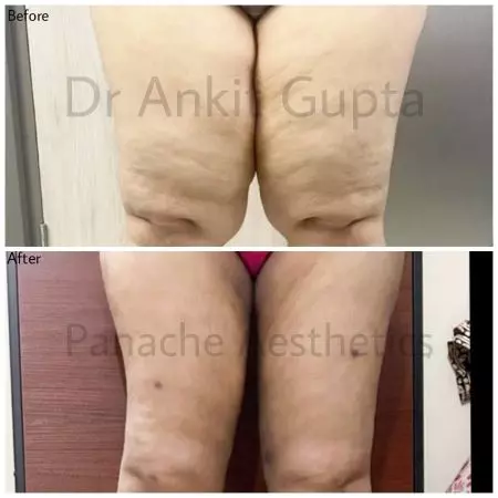 Thigh liposuction before and after — slimmer thighs — Dr. Ankit Gupta, Panache Aesthetics Delhi