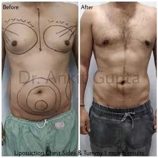 360 degree liposuction before and after — abdomen and flanks — Dr. Ankit Gupta, Panache Aesthetics Delhi