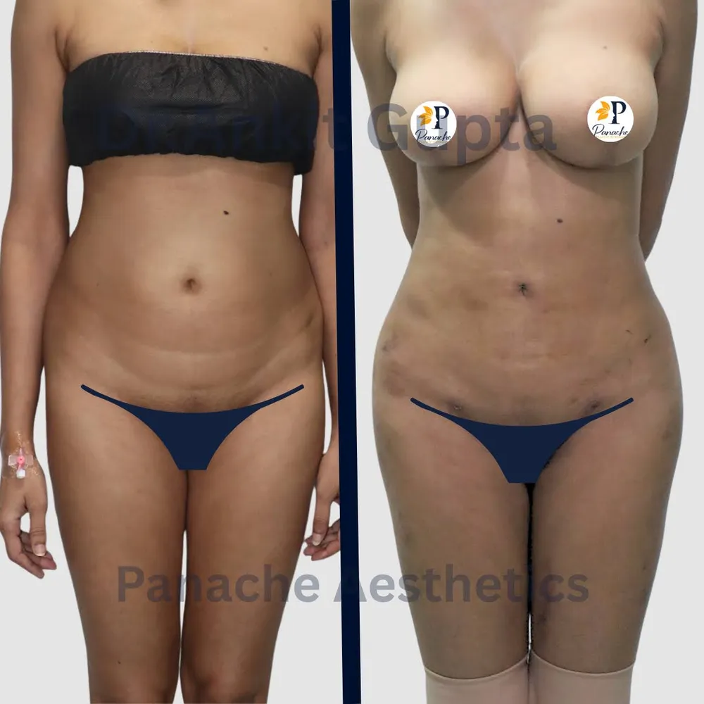 Tummy liposuction in Delhi before and after — flatter abdomen and trimmer waistline — Panache Aesthetics