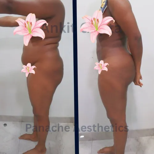 Waist and flank 360° liposuction before and after — side profile in Delhi — Dr. Ankit Gupta