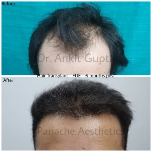 Hair Transplant before after panache aesthetics 1