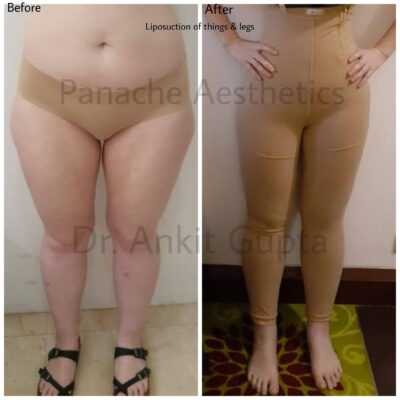 liposuction before after panache aesthetics