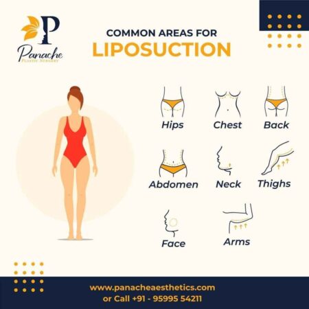 Areas of Liposuction at Panache aesthetics Liposuction at Panache aesthetics