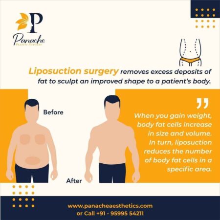 Liposuction at Panache aesthetics