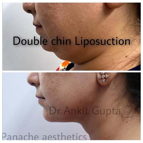double chin removal by liposuction, Liposuction before after patient results