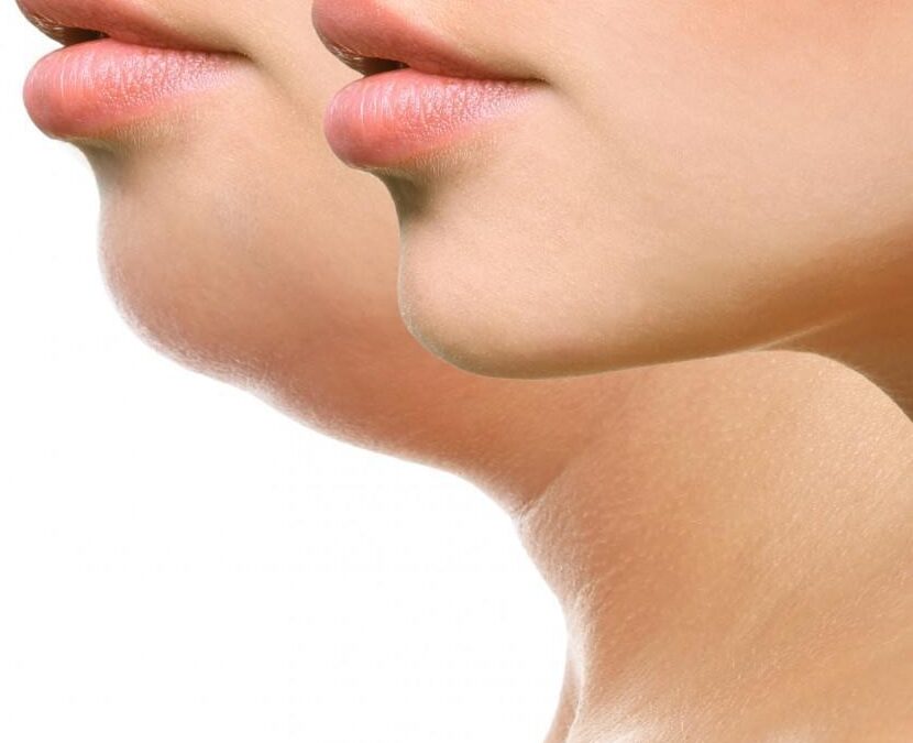 double chin liposuction