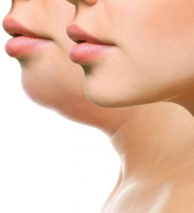 Double Chin Removal: Best, Safe & Affordable