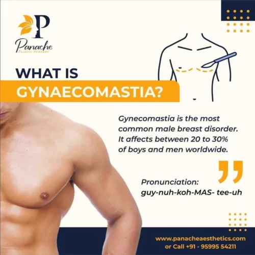 what is gynecomastia panache aesthetics