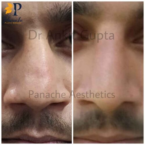 Rhinoplasty, nose surgery, patient before after results