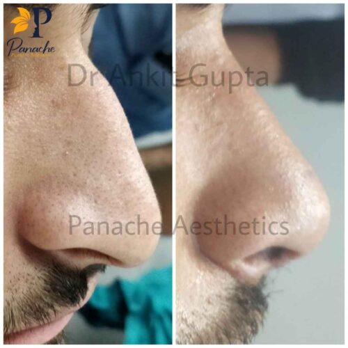 Rhinoplasty, nose surgery, patient before after results