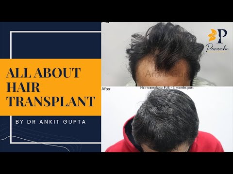 Hair Transplant - Best, Affordable & Result Oriented, Delhi