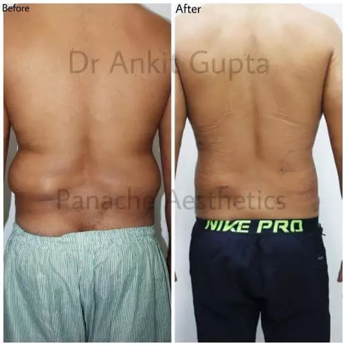 Abdomen Liposuction before after patient results