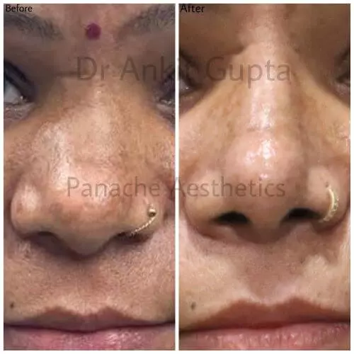 Rhinoplasty nose job before after