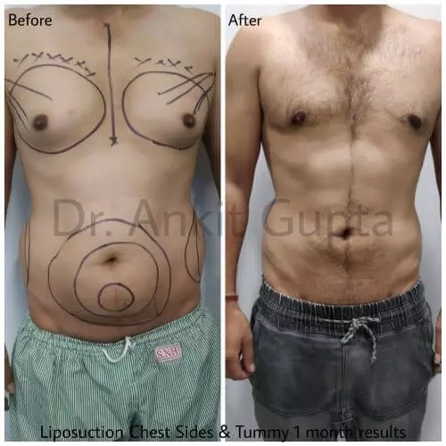 liposuction abdomen before after patient results