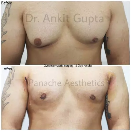 gynecomastia before after panache aesthetics 5 Gynaecomastia before after panache aesthetics
