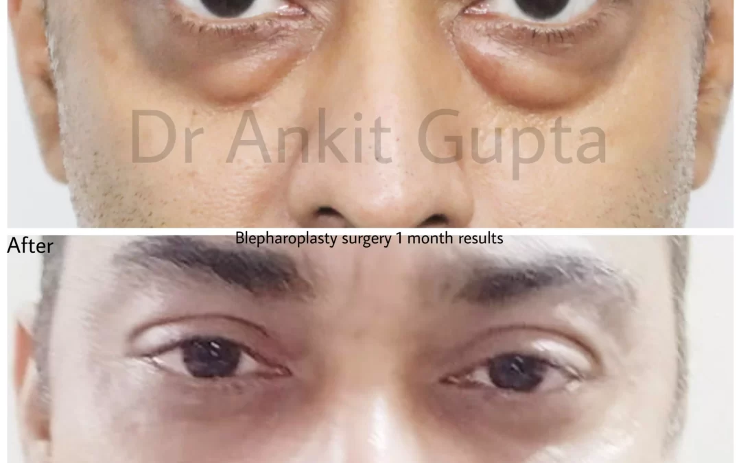 Eye Bag Surgery: A Case Study