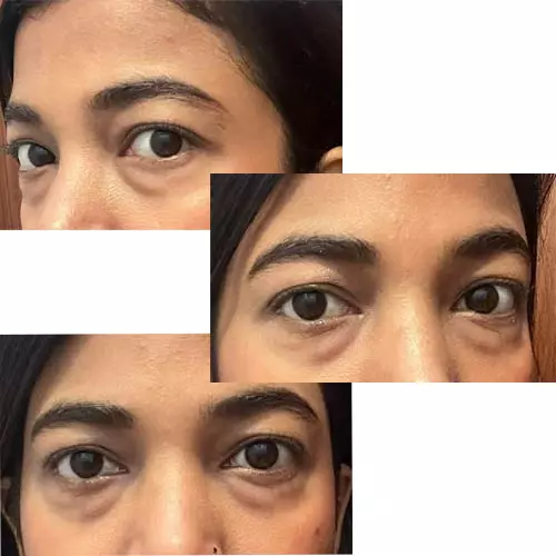 Four eyelid surgery