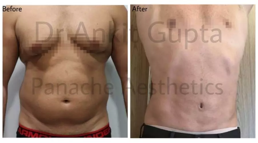 Liposuction patient results, best liposuction surgery in delhi