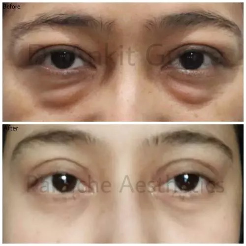 Best Blepharoplasty Surgery in Delhi: 12+ years experience