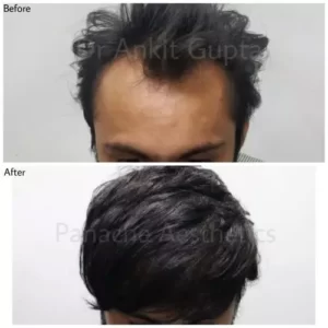 hairline transplant with hair grafts for hair growth surgery, also known as hair follicle surgery at Delhi's best hair transplant clinic