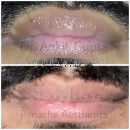 Lip reduction surgery delhi