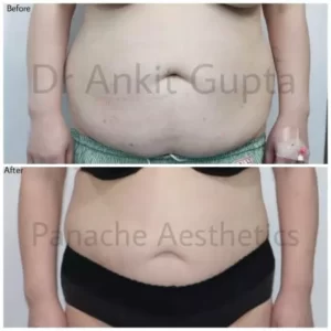 Best Vaser assisted Liposuction in delhi