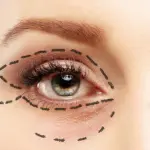blepharoplasty blepharoplasty 1