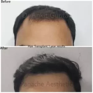 best hair transplant doctor in delhi