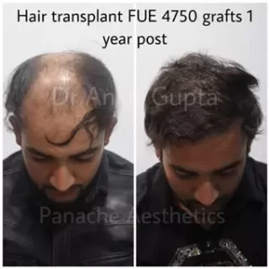 best hair transplant clinic in delhi for guaranteed hair transplant treatment