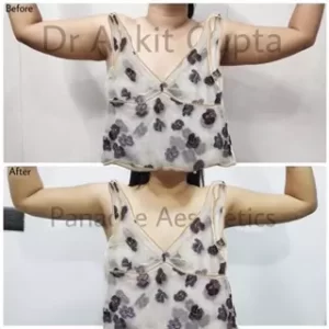Vaser Liposuction in Delhi