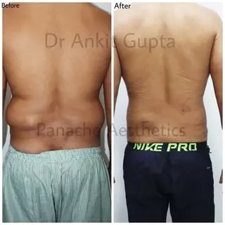 best liposuction surgeon in delhi for love handles
