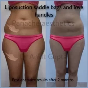 Vaser Assisted Lipo in Delhi