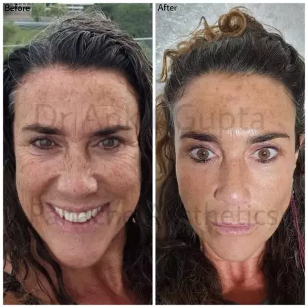 Fat grafting Fat Grafting Surgery in DElhi patient results. FAt Grafting for facial rejuvenation