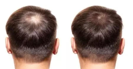 exosome therapy for hair exosome therapy for hair